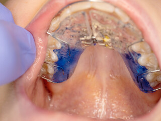 Dental treatment of adjustable  braces on teeth