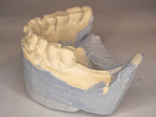 Model of plaster cast of lower teeth.  Missing teeth due to birth defect.