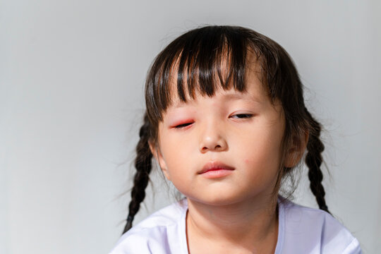 Asian girl with red pink eye inflammation blepharitis from allergy