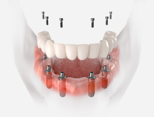 Restoration of mandible with 6 implants. 3D illustration of dental prosthesis on white background.