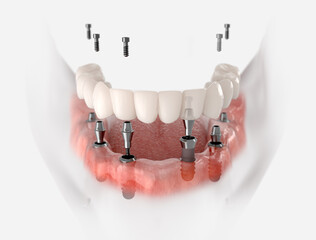 Restoration of mandible with 6 implants. 3D illustration of dental prosthesis on white background.