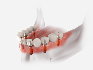 Restoration of mandible with 6 implants. 3D illustration of dental prosthesis on white background.