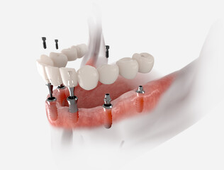 Restoration of mandible with 6 implants. 3D illustration of dental prosthesis on white background.