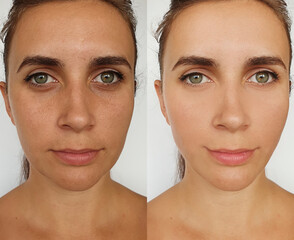 woman face wrinkles before and after treatment