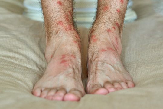 Male legs with many red spot and scar from insect bite.