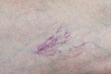 Varicose veins on the leg close-up. The concept of the need for the help of a phlebologist.