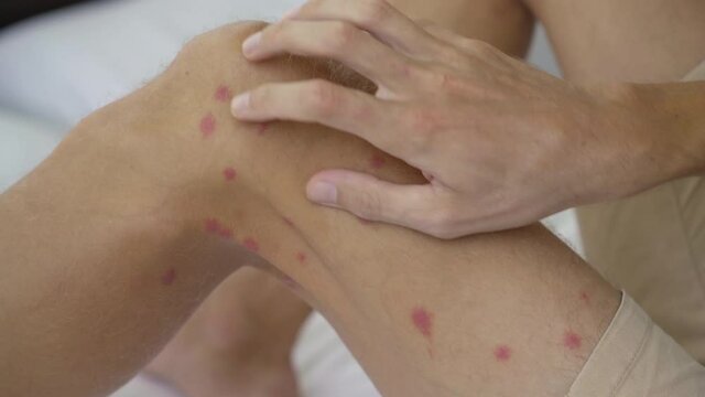 A man sitting on a bed scratching his legs. He was severely bitten by mosquitoes or other biting bugs