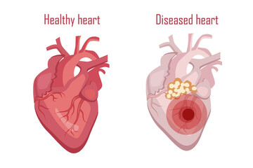 Human heart, circulatory system. Sick and healthy heart, vector illustration