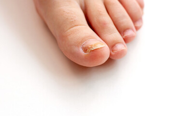 Close-up of toenail with fungus infection. Infectious disease of the nail plate. © epovdima