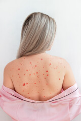 chickenpox in an adult girl, pinch on the back