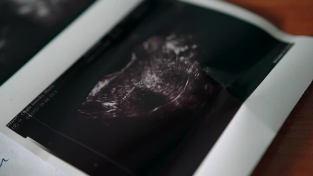 Ultrasound pregnancy fertility scan image in medical clinic dolly right