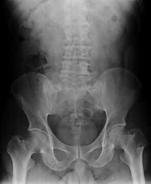 x-ray images of spine,pelvis,hip joint of patient.