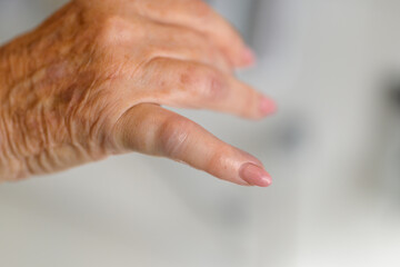 Broken or fractured finger of a senior woman