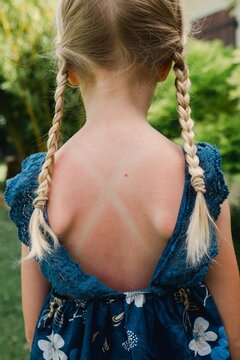 stock photo of little blonde girl with braids and her back in sunburnt