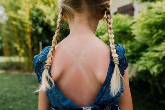 stock photo of little blonde girl with braids and her back in sunburnt