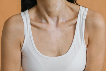 Vitiligo skin