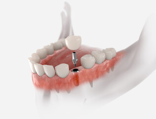 Dental crown, abutment and implant. 3D illustration of human teeth and dentures on white background.