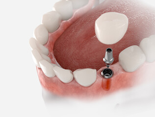 Dental crown, abutment and implant. 3D illustration of human teeth and dentures on white background.