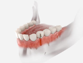 Dental crown, abutment and implant. 3D illustration of human teeth and dentures on white background.