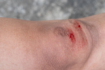 Fototapeta premium The knee is scratched. Close up on an bleeding scraped child his knee after run accident.