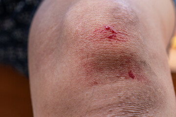 Fototapeta premium The knee is scratched. Close up on an bleeding scraped child his knee after run accident.