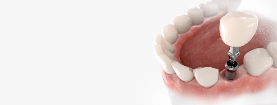 Dental crown, abutment and implant. 3D illustration of human teeth and dentures on white background.