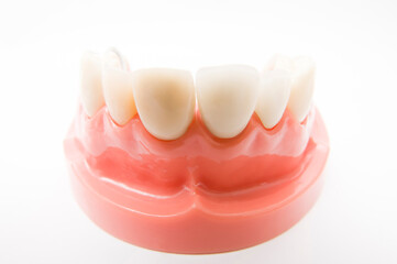 部分入歯の模型