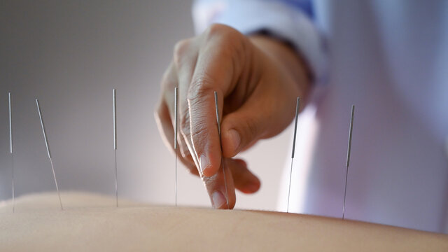acupuncture young women.