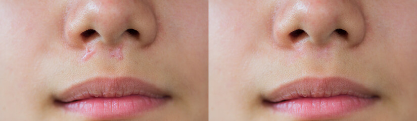 Image before and after laser treatment of keloid scar caused by accident in children, skin...