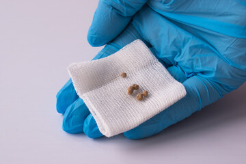 The gallbladder stones after ESWL intervention. Lithotripsy. Cholecystitis.