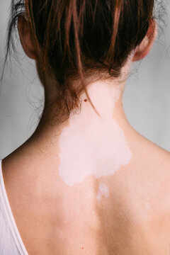 Closeup of a Woman with Vitiligo