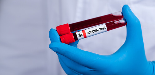 Coronavirus 2019-nCoV Blood Sample.