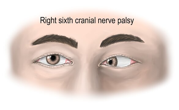 right abducen nerve palsy presents with lateral rectus palsy.