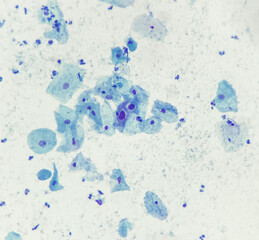 Photo of Low grade squamous intraepithelial lesion (LSIL), showing few koilocytes, photo under...