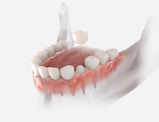Dental crown placement process. 3d illustration on whit background.