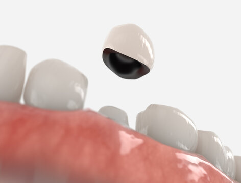 Dental crown placement process. 3d illustration on whit background.