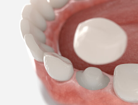 Dental crown placement process. 3d illustration on whit background.