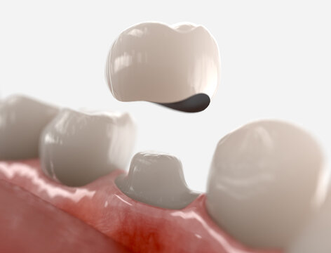 Dental crown placement process. 3d illustration on whit background.