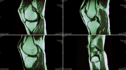 Radiologie: Vier MRT-Aufnahmen eines männlichen Knies - mit Meniskusriss - obrazy, fototapety, plakaty