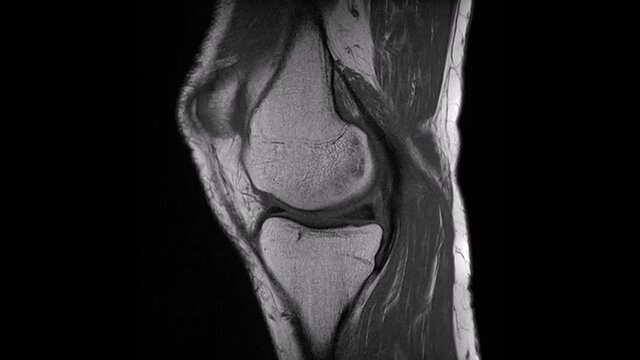Radiologie: Serie von Einzelbildern - MRT-Aufnahmen eines m&auml;nnlichen Knies - mit Meniskusriss