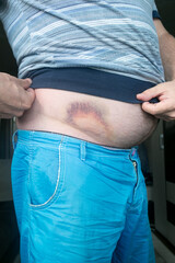 Bruise, hematoma on the human body Large bruise, bruise on the stomach of a man after injury.