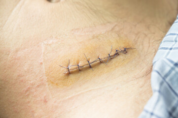 Nurse or Doctor hand treating the wound patient to clean the wound after stitches patients...