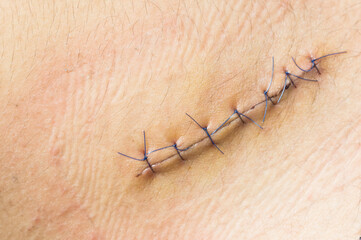 Nurse or Doctor hand treating the wound patient to clean the wound after stitches patients...