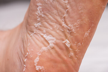 Fototapeta premium Skin peeling on the sole of a foot.