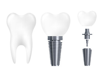 Dental implant parts - realistic white tooth with titanium metal screw