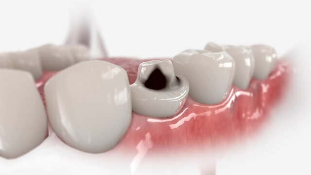 Restoration process of a decayed tooth by means of a dental crown. 