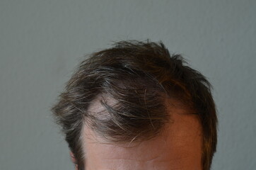 Hair loss man. Close up on male scalp lossing hair.