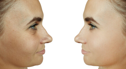 woman face wrinkles before and after treatment collage