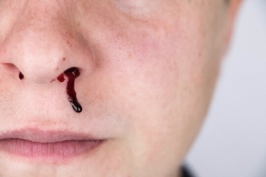 The man's nose started bleeding. High blood pressure caused blood vessels to rupture. A thin red trickle flows out of the sinuses. Consequences of vascular problems and severe stress