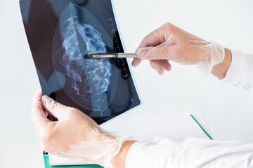 Female doctor analyzing mammography results on x-ray